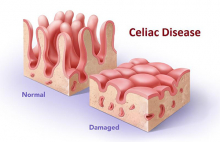 visual of healthy vs. damaged villi due to celiac disease